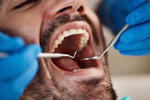 Best Emergency Tooth Extraction in Diamond, IL